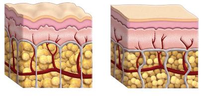 beeld van doorsnede vet huid en opperhuid onderhuids bindweefsel 