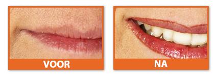 permanente make-up lipcontour  permanente make-up lipcontour Hilde van Peer